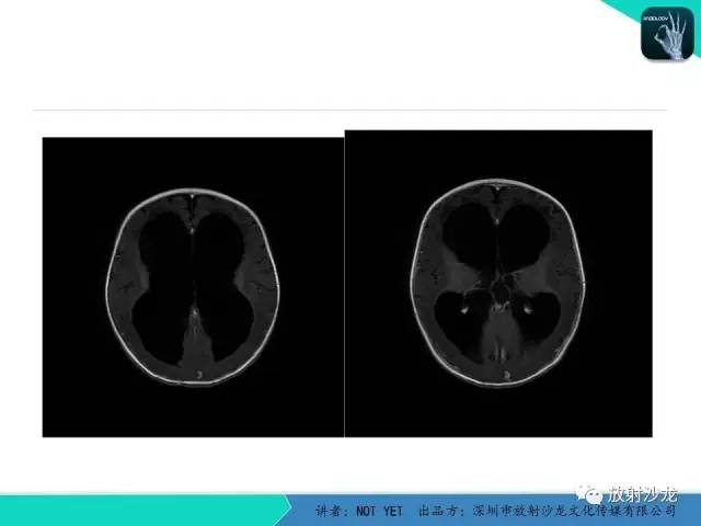 【病例】小儿后颅凹巨大蛛网膜囊肿1例MR