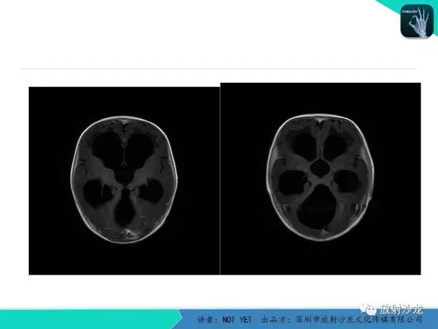【病例】小儿后颅凹巨大蛛网膜囊肿1例MR
