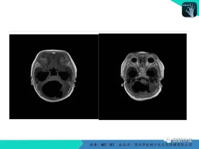 【病例】小儿后颅凹巨大蛛网膜囊肿1例MR