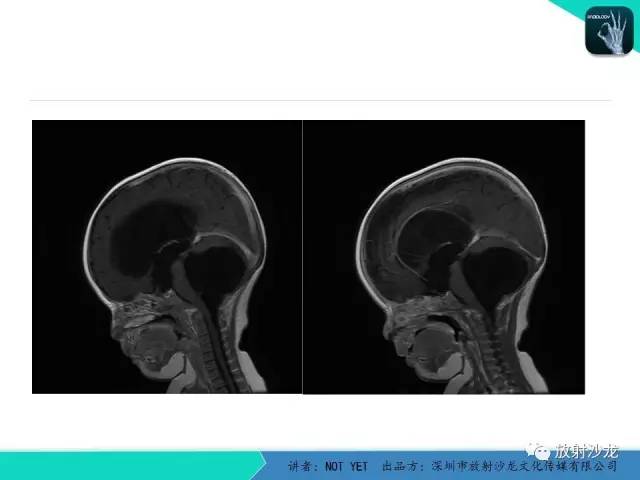 【病例】小儿后颅凹巨大蛛网膜囊肿1例MR