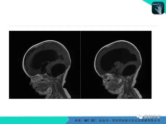 【病例】小儿后颅凹巨大蛛网膜囊肿1例MR