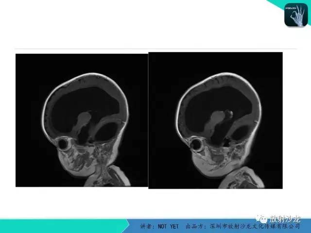 【病例】小儿后颅凹巨大蛛网膜囊肿1例MR