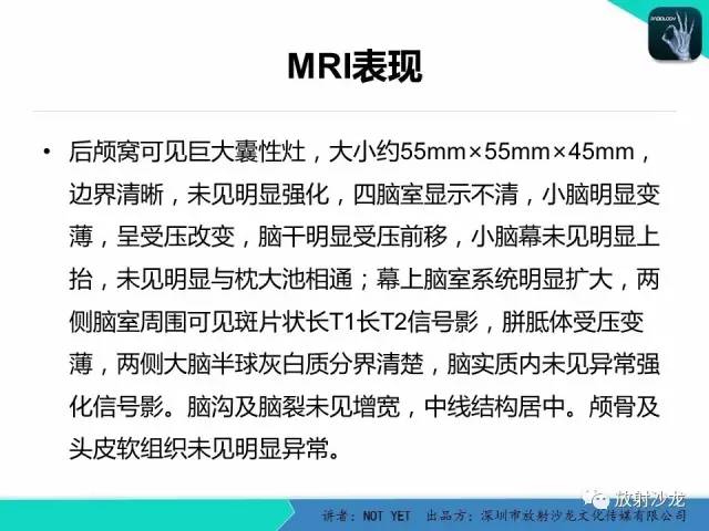 【病例】小儿后颅凹巨大蛛网膜囊肿1例MR