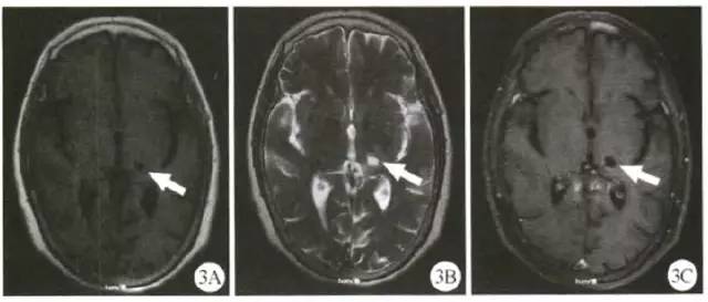 一例被误诊为脑肿瘤的脑出血MRI,你会犯这种错误吗? 一例被误诊为脑肿瘤的脑出血MRI,你会犯这种错误吗?