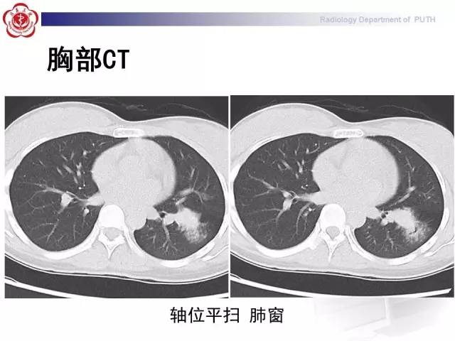 【病例】肺粘液表皮样癌1例CT