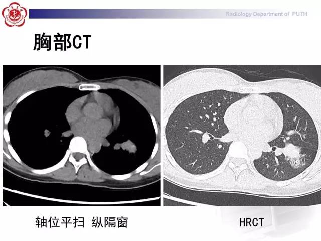 【病例】肺粘液表皮样癌1例CT
