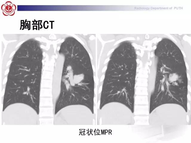 【病例】肺粘液表皮样癌1例CT