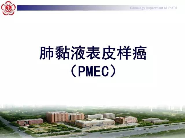 【病例】肺粘液表皮样癌1例CT