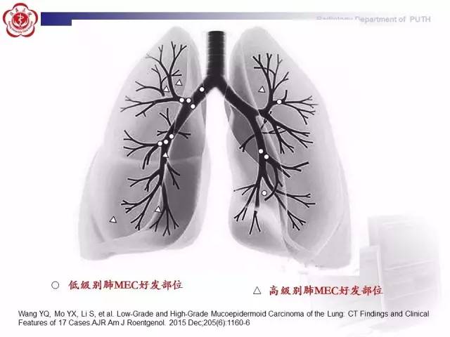 【病例】肺粘液表皮样癌1例CT