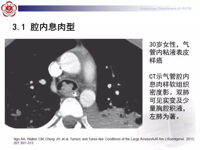 【病例】肺粘液表皮样癌1例CT