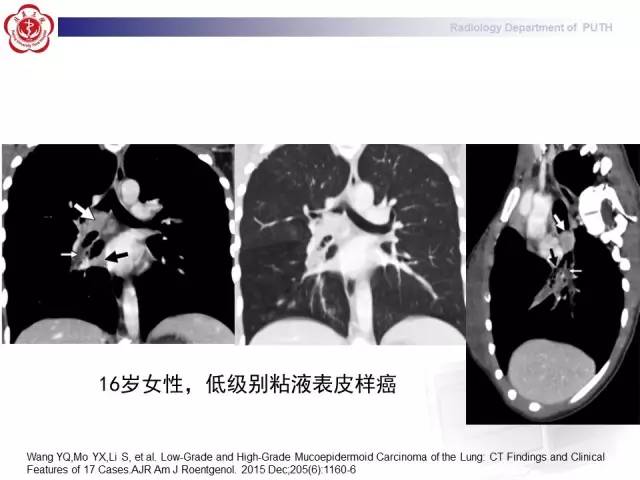 【病例】肺粘液表皮样癌1例CT