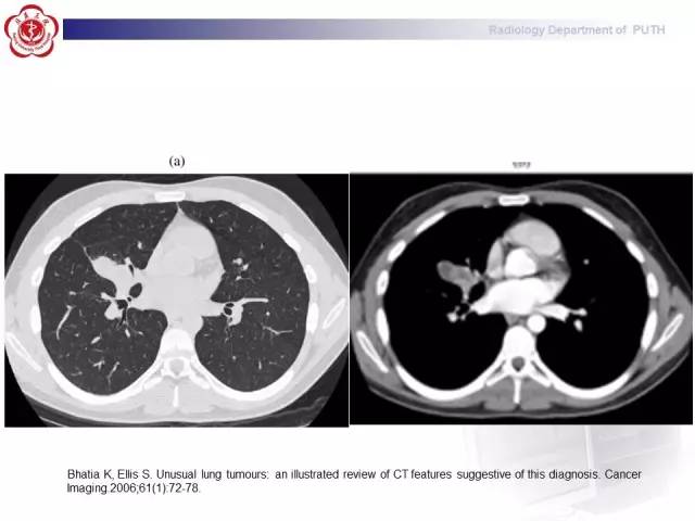 【病例】肺粘液表皮样癌1例CT