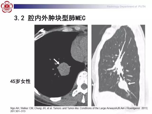 【病例】肺粘液表皮样癌1例CT
