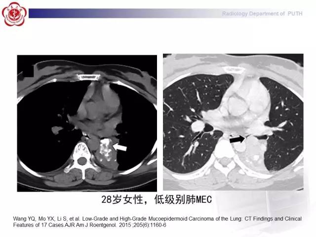 【病例】肺粘液表皮样癌1例CT