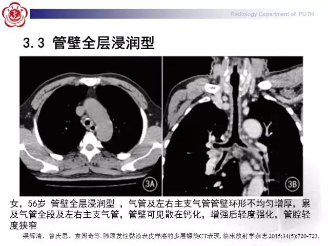 【病例】肺粘液表皮样癌1例CT