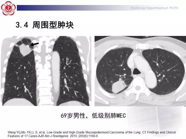 【病例】肺粘液表皮样癌1例CT