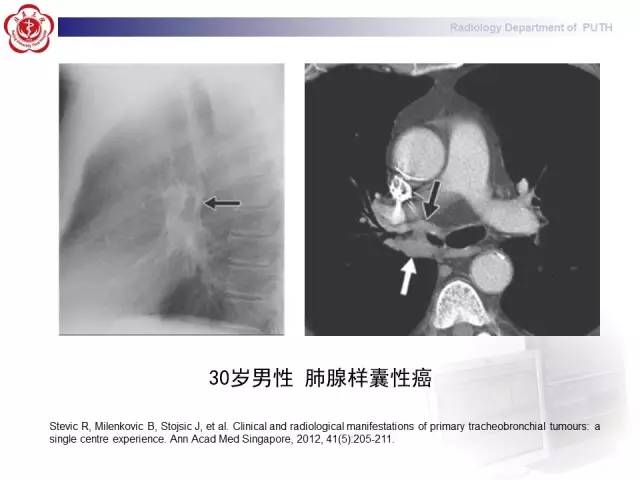 【病例】肺粘液表皮样癌1例CT