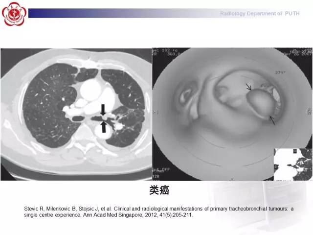 【病例】肺粘液表皮样癌1例CT