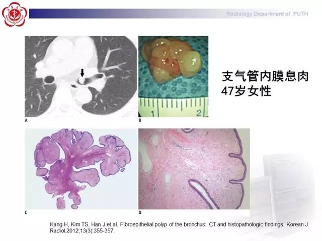 【病例】肺粘液表皮样癌1例CT