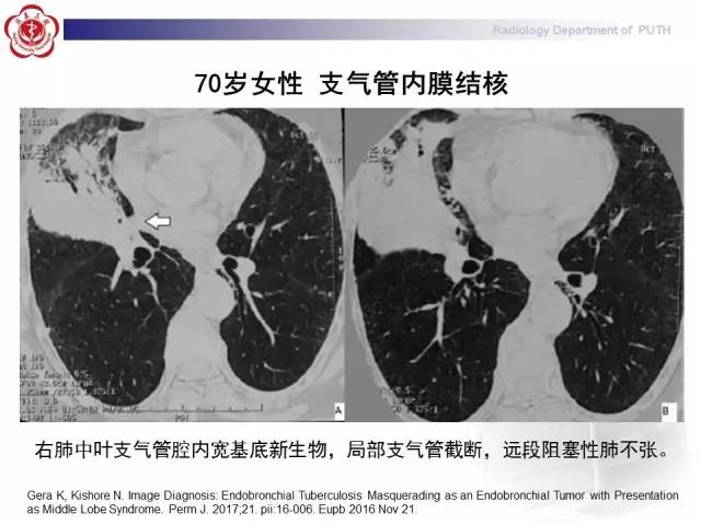 【病例】肺粘液表皮样癌1例CT