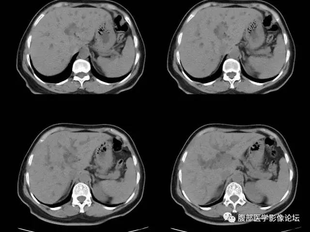 【病例】胰腺头部粘液腺癌1例CT影像表现 【病例】胰腺头部粘液腺癌1例CT影像表现