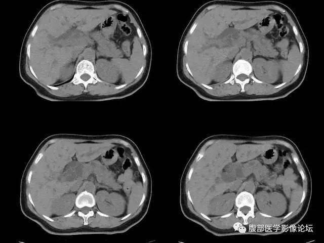 【病例】胰腺头部粘液腺癌1例CT影像表现 【病例】胰腺头部粘液腺癌1例CT影像表现