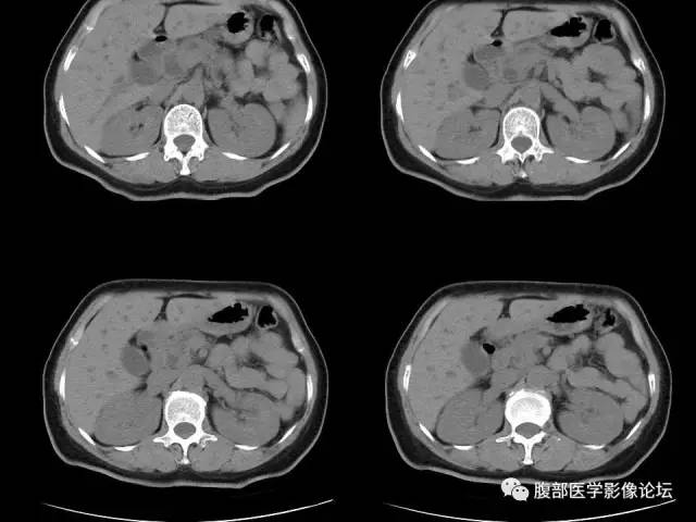 【病例】胰腺头部粘液腺癌1例CT影像表现 【病例】胰腺头部粘液腺癌1例CT影像表现