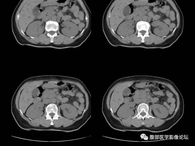 【病例】胰腺头部粘液腺癌1例CT影像表现 【病例】胰腺头部粘液腺癌1例CT影像表现