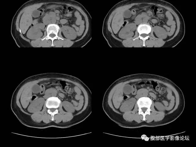 【病例】胰腺头部粘液腺癌1例CT影像表现 【病例】胰腺头部粘液腺癌1例CT影像表现