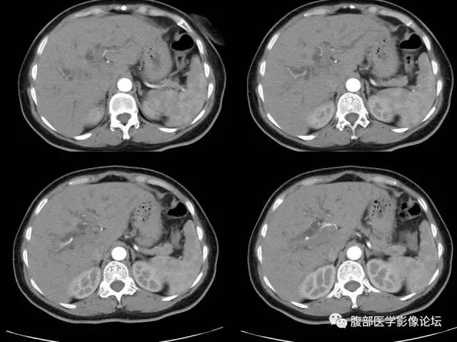 【病例】胰腺头部粘液腺癌1例CT影像表现 【病例】胰腺头部粘液腺癌1例CT影像表现