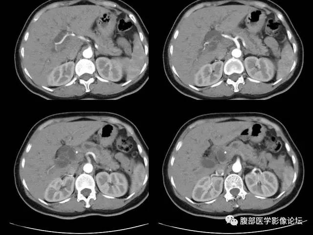 【病例】胰腺头部粘液腺癌1例CT影像表现 【病例】胰腺头部粘液腺癌1例CT影像表现