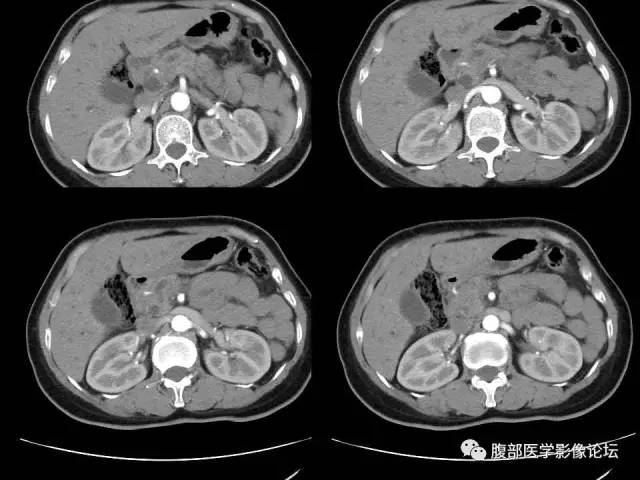 【病例】胰腺头部粘液腺癌1例CT影像表现 【病例】胰腺头部粘液腺癌1例CT影像表现