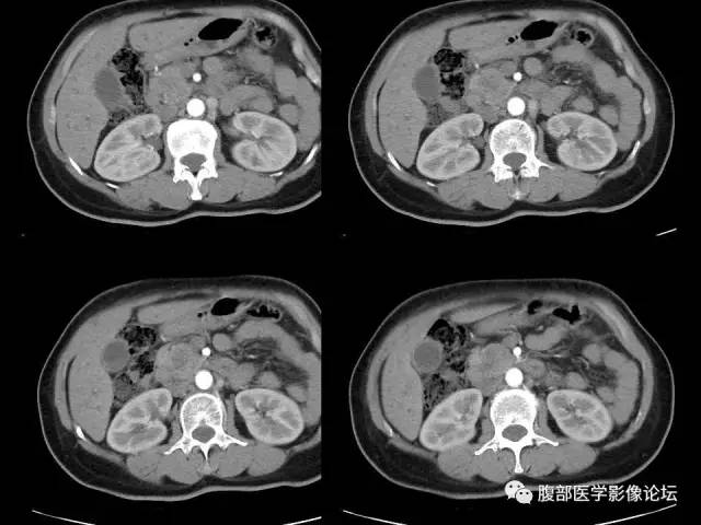 【病例】胰腺头部粘液腺癌1例CT影像表现 【病例】胰腺头部粘液腺癌1例CT影像表现