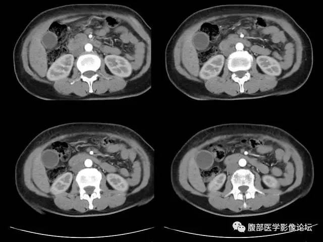 【病例】胰腺头部粘液腺癌1例CT影像表现 【病例】胰腺头部粘液腺癌1例CT影像表现