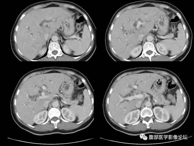 【病例】胰腺头部粘液腺癌1例CT影像表现 【病例】胰腺头部粘液腺癌1例CT影像表现