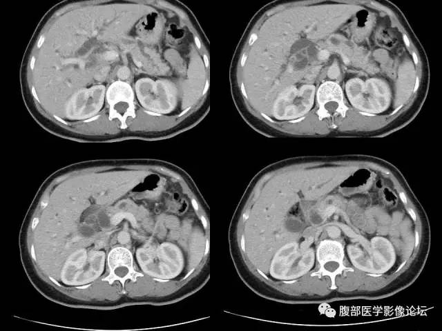 【病例】胰腺头部粘液腺癌1例CT影像表现 【病例】胰腺头部粘液腺癌1例CT影像表现