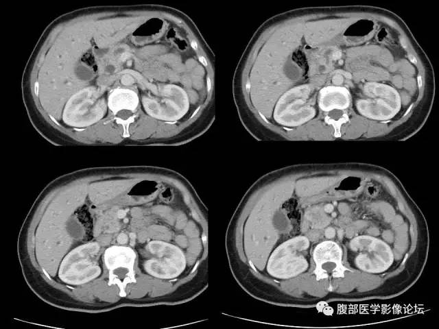 【病例】胰腺头部粘液腺癌1例CT影像表现 【病例】胰腺头部粘液腺癌1例CT影像表现