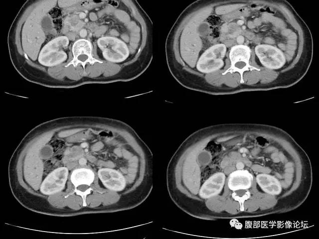 【病例】胰腺头部粘液腺癌1例CT影像表现 【病例】胰腺头部粘液腺癌1例CT影像表现