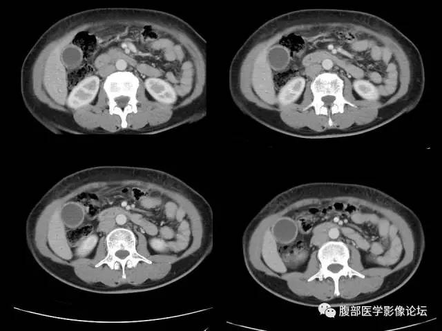 【病例】胰腺头部粘液腺癌1例CT影像表现 【病例】胰腺头部粘液腺癌1例CT影像表现