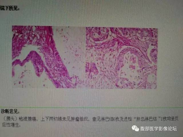 【病例】胰腺头部粘液腺癌1例CT影像表现 【病例】胰腺头部粘液腺癌1例CT影像表现