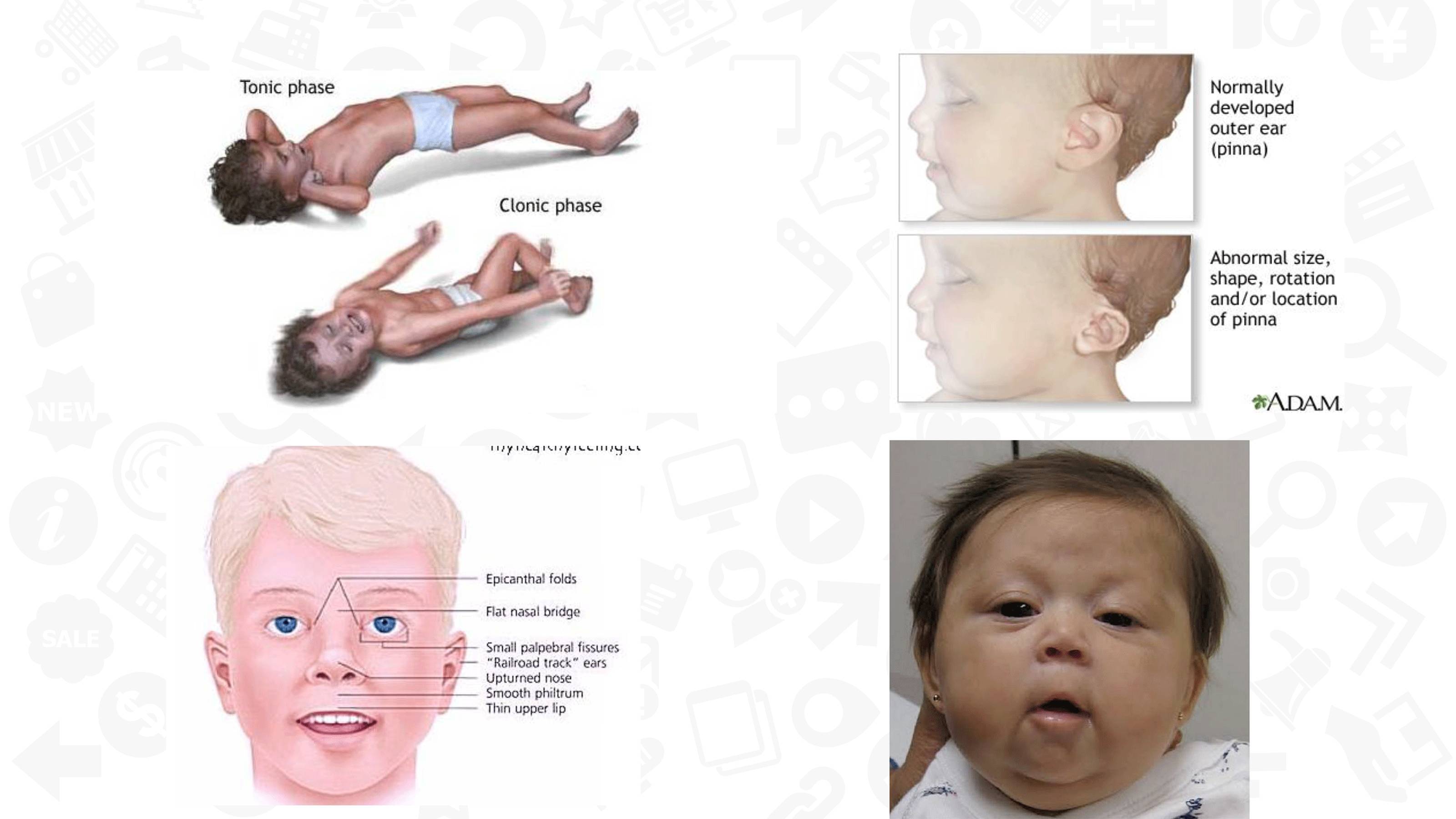 【PPT】Chiari 1 【PPT】Chiari 1