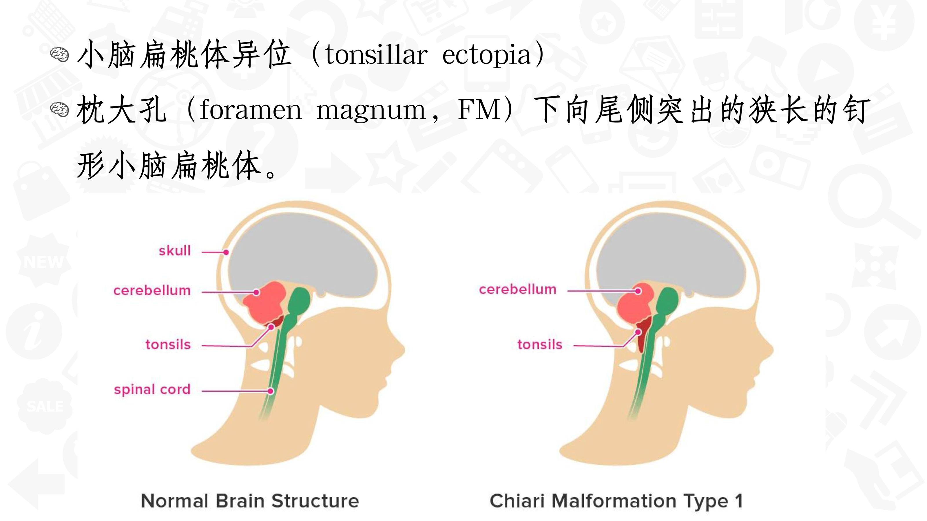 【PPT】Chiari 1 【PPT】Chiari 1