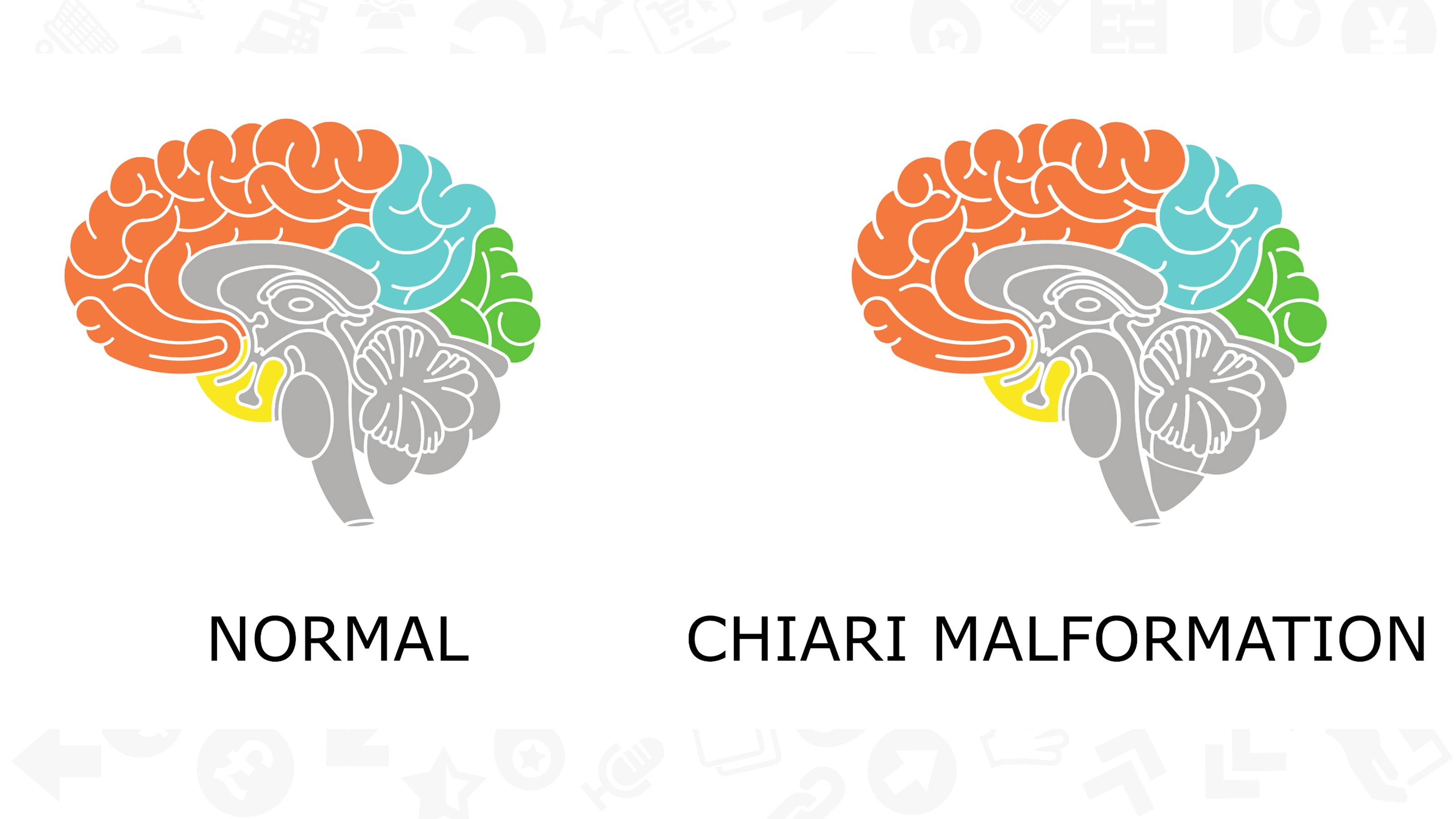 【PPT】Chiari 1 【PPT】Chiari 1