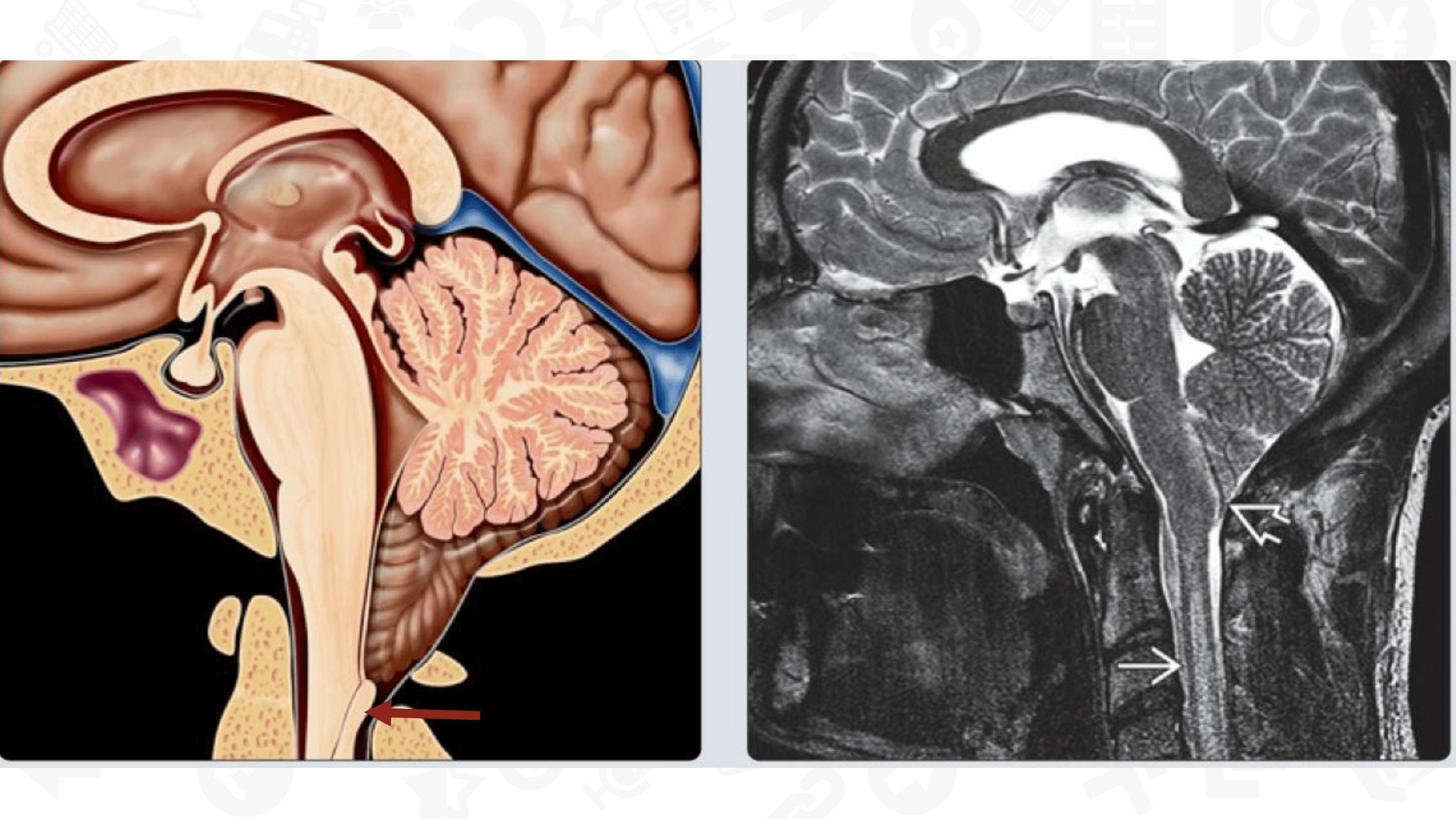 【PPT】Chiari 1 【PPT】Chiari 1