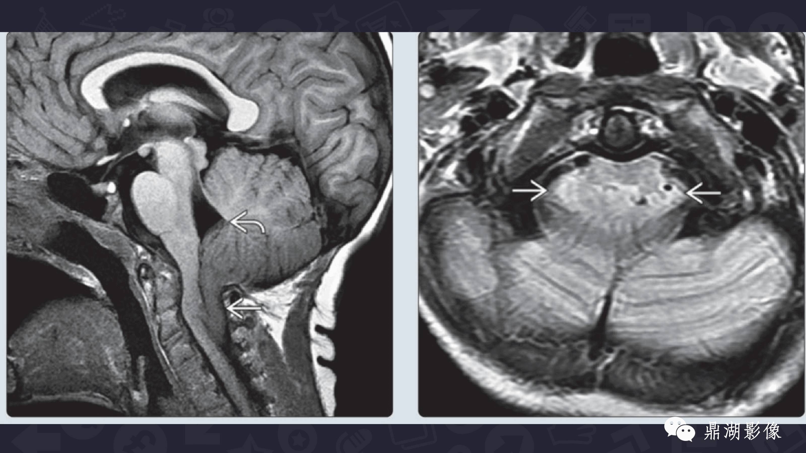 【PPT】Chiari 1 【PPT】Chiari 1