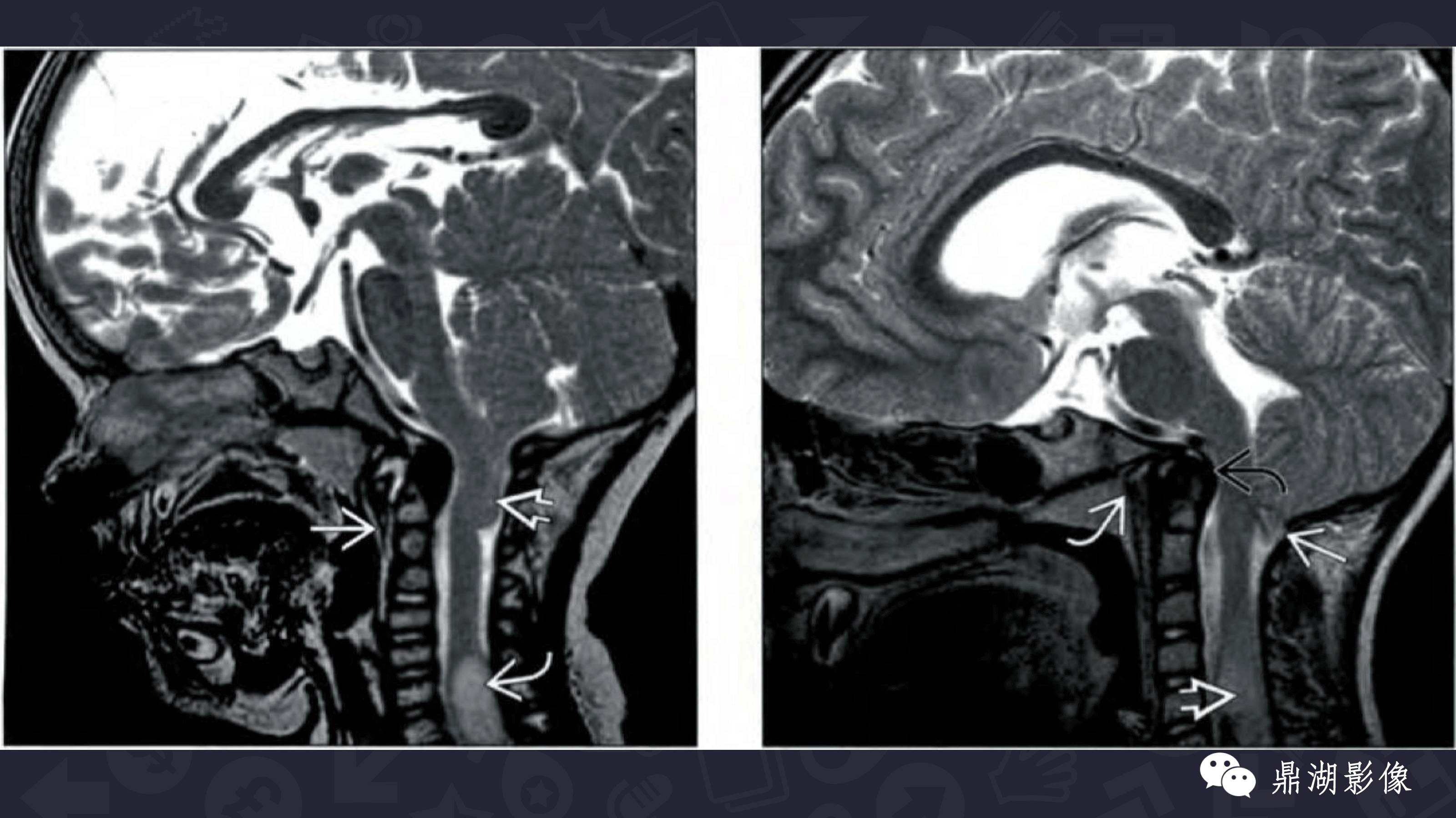 【PPT】Chiari 1 【PPT】Chiari 1