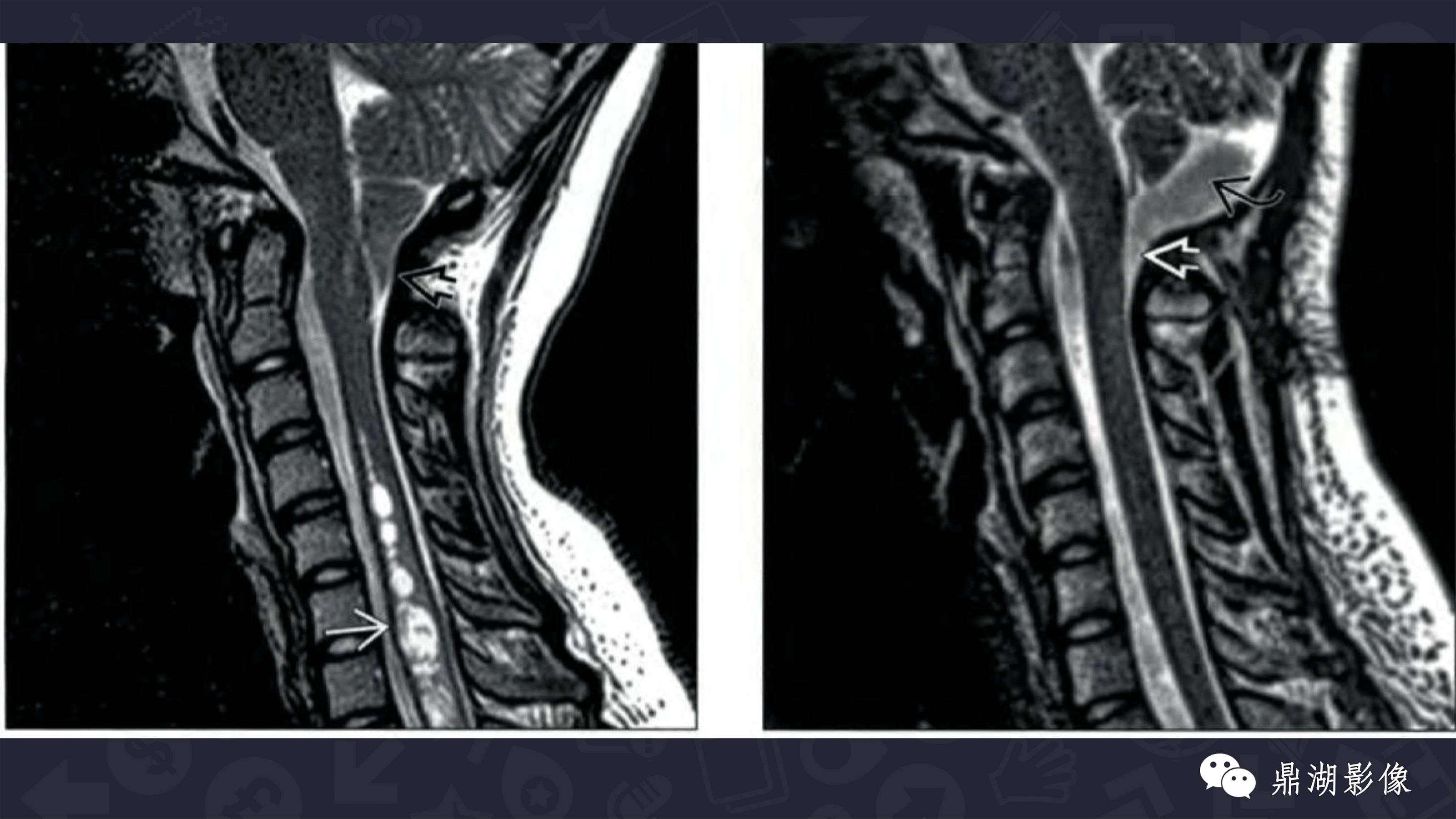 【PPT】Chiari 1 【PPT】Chiari 1