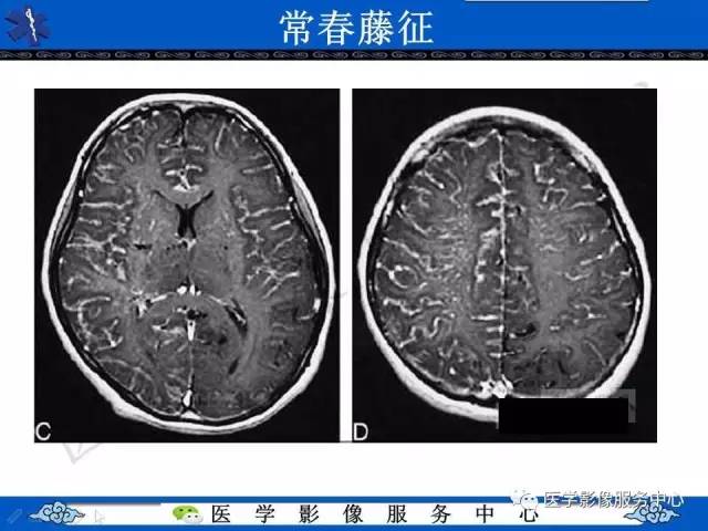 【影像征象】常春藤征