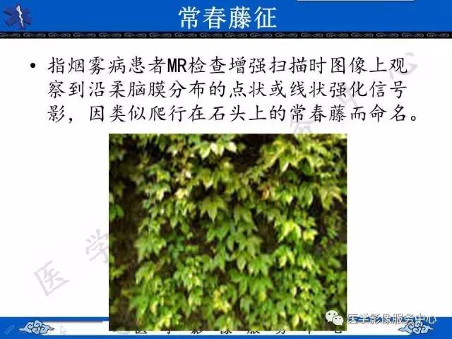 【影像征象】常春藤征