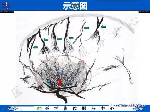 【影像征象】常春藤征